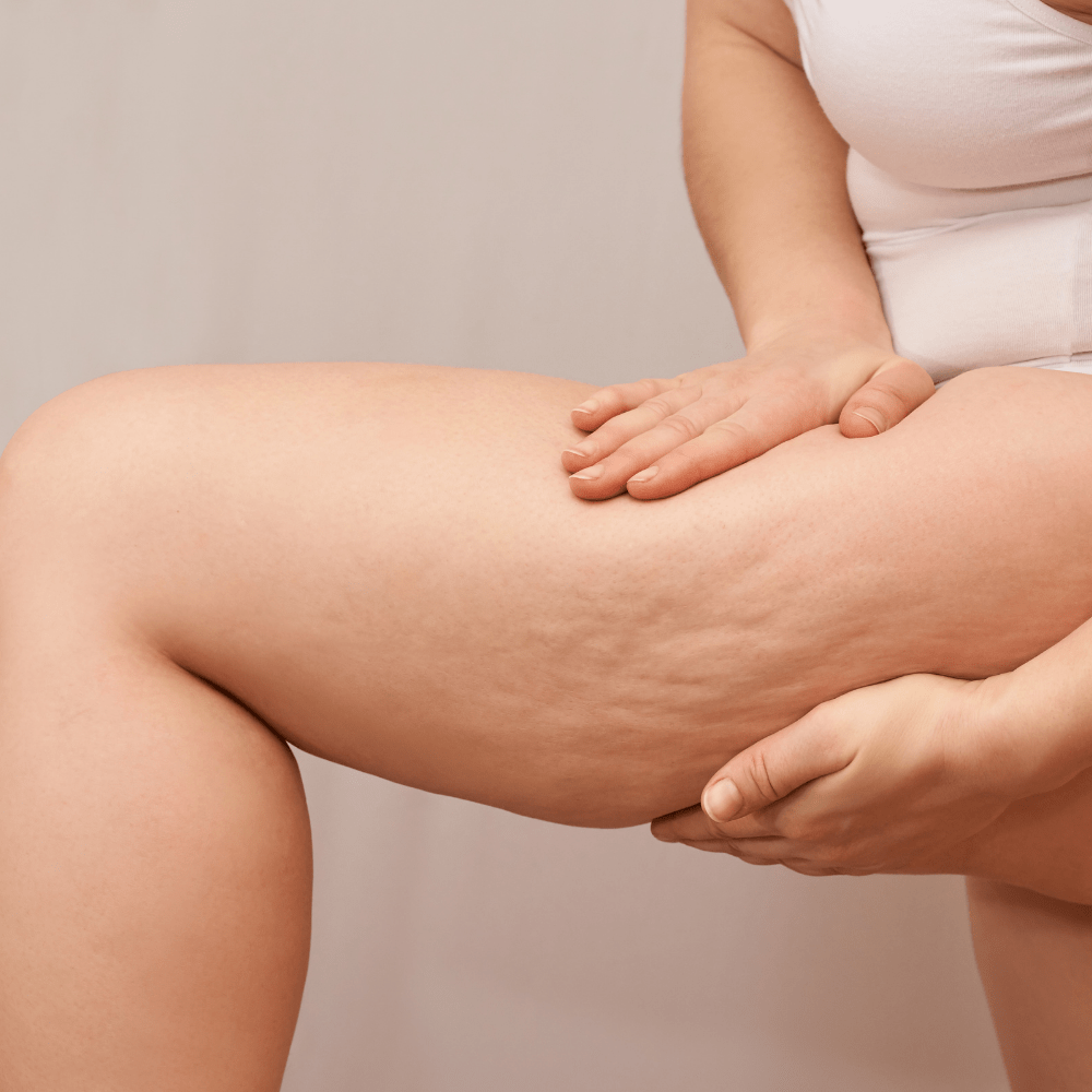 Cesmed-medica-fisioterapia-linfotecar-cellulite